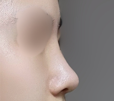 Nose worries settled