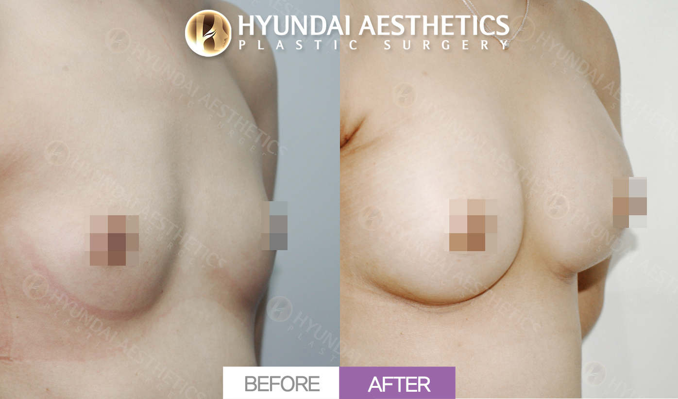 Breast Augmentation (Round Implants)