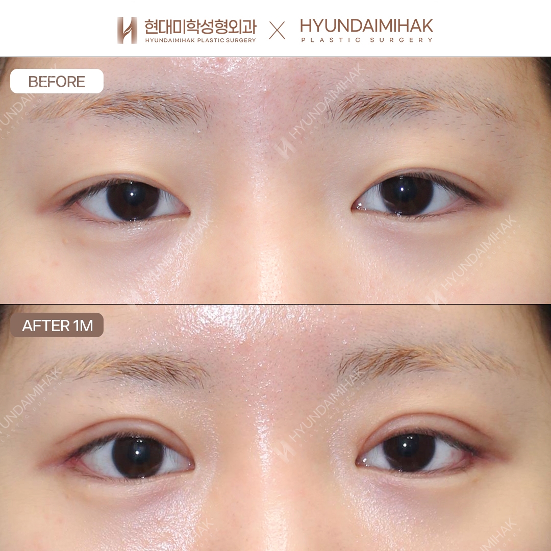 [Revision Eye Surgery] Incisional Double-Eyelid Revision + Dual Canthoplasty