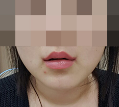 I had mouth-corner surgery~~