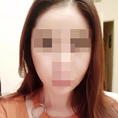 Cheekbone reduction is amazing ㅎㅎ