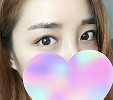 Double eyelid surgery review!! It turned out so well haha