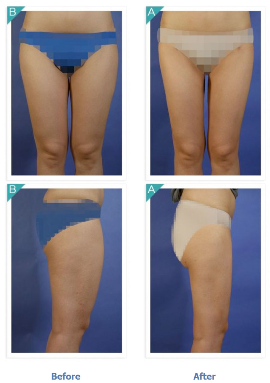 Body Contouring / Thigh Liposuction
