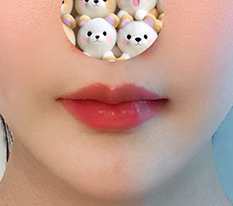 Cupid's bow surgery without scars