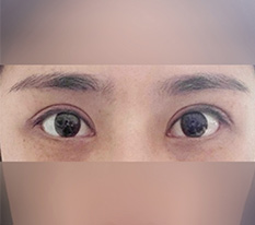I am really glad I had revision eye surgery at Hyundai Aesthetic Surgery haha
