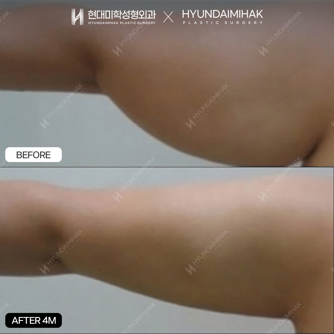 Arm Liposuction, 4 Months Later