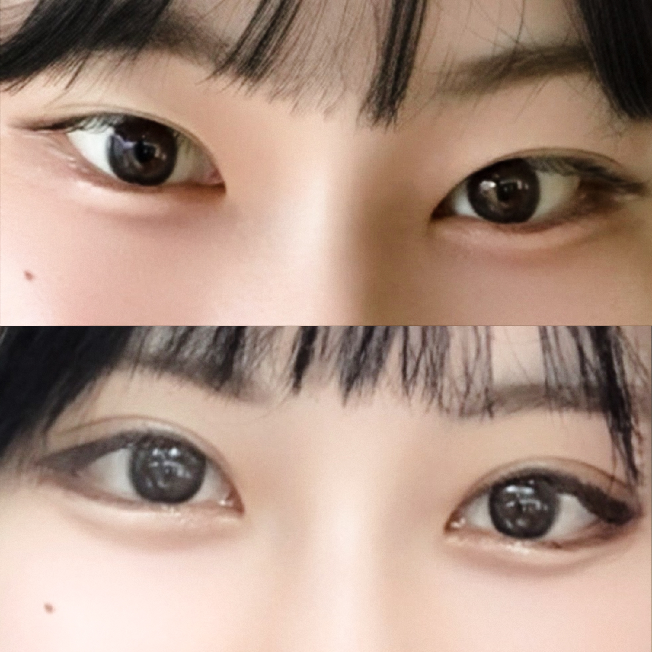 Eye revision with dual canthoplasty made my eyes look gentler