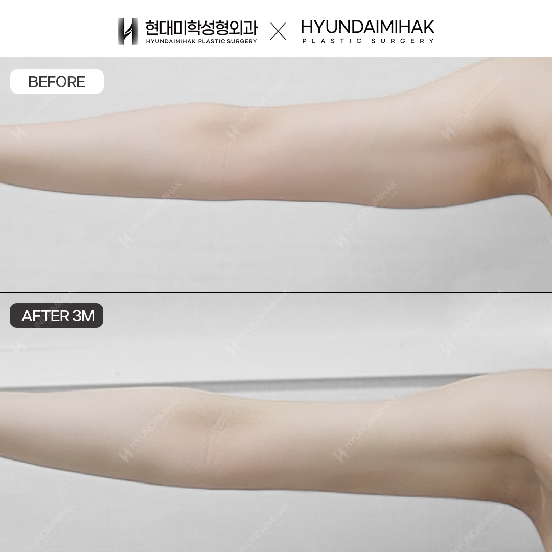 Arm Liposuction, 3 Weeks