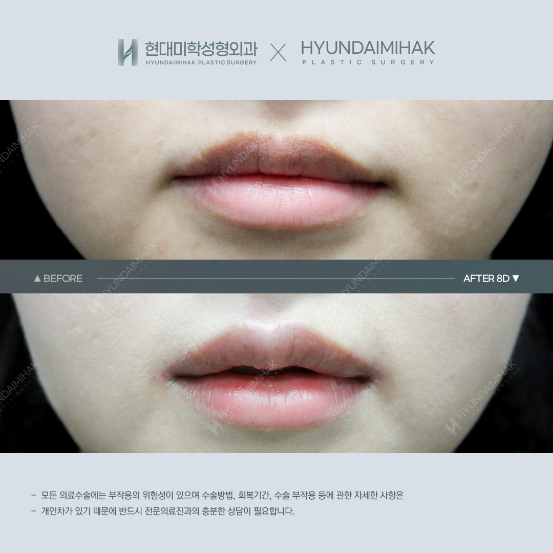 [Lip Surgery] Cupid's Bow Lip Surgery, 1 Month