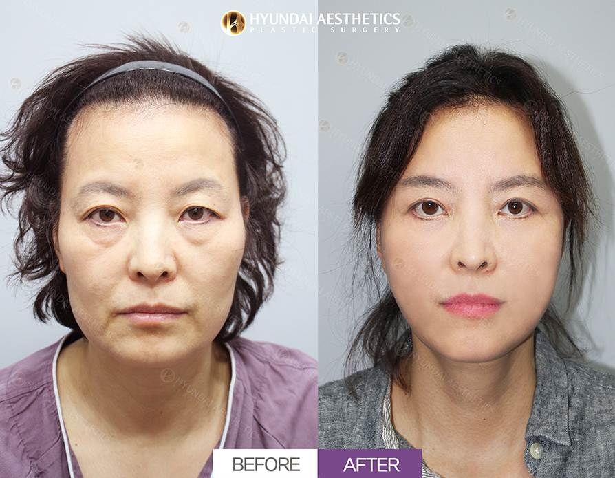 Upper Blepharoplasty + Lower Blepharoplasty + Under-Eye Fat Repositioning + Double-Eyelid Surgery