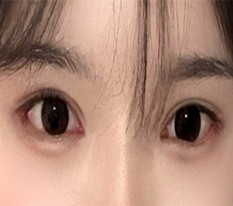 I got glamorous eyes with incisional double eyelids + full canthoplasty