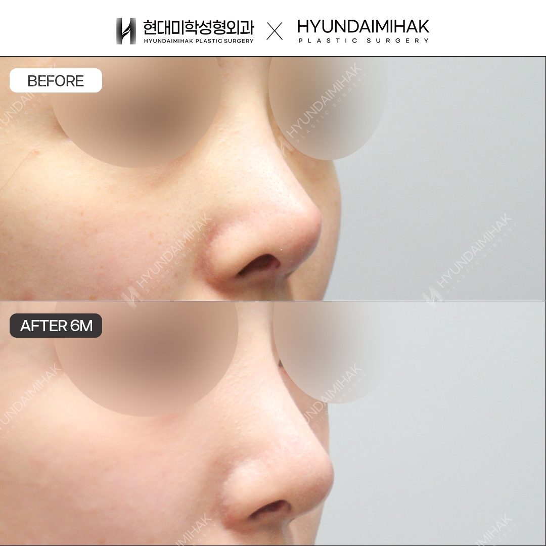[Revision rhinoplasty] Nasal bridge + nasal tip, 6 months post-op