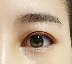 It's been a week since my eyelid revision surgery^^