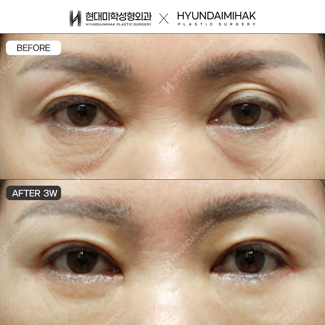 [Middle-Aged Eye Surgery] Asymmetrical Eye Correction + Upper Blepharoplasty + Lower Blepharoplasty