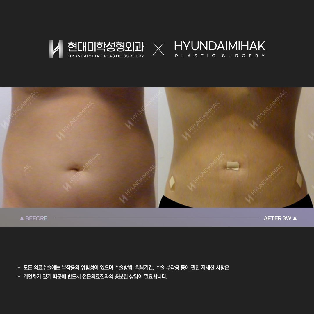 3 weeks after abdominal liposuction