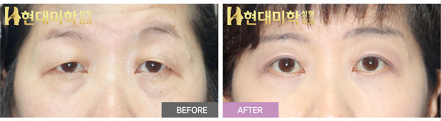 Upper Blepharoplasty, Ptosis Correction, Lower Blepharoplasty