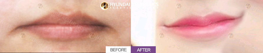 Mouth Corner Lift