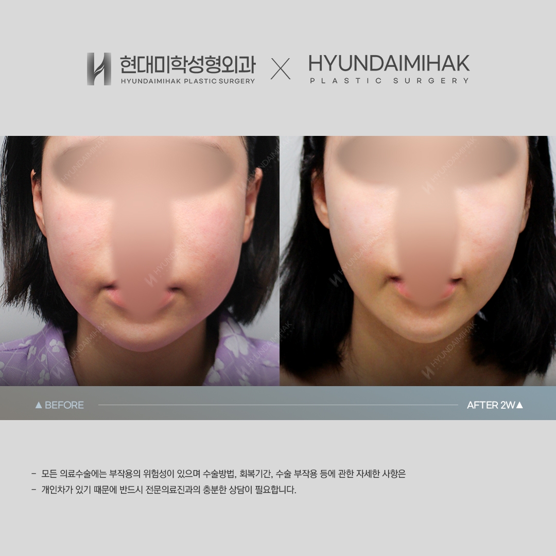 [Anti-aging Surgery] Thread lift, 2 weeks