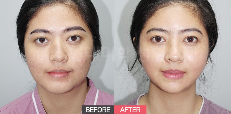 Fat Grafting (Cheeks, Temples, Forehead) + Lower Blepharoplasty + Deep Cheek Fat Removal + Venus Double Chin + Thread Lifting