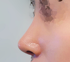 Clean correction of a hooked nose