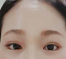 I like that my eyes look clearer after a forehead lift^^