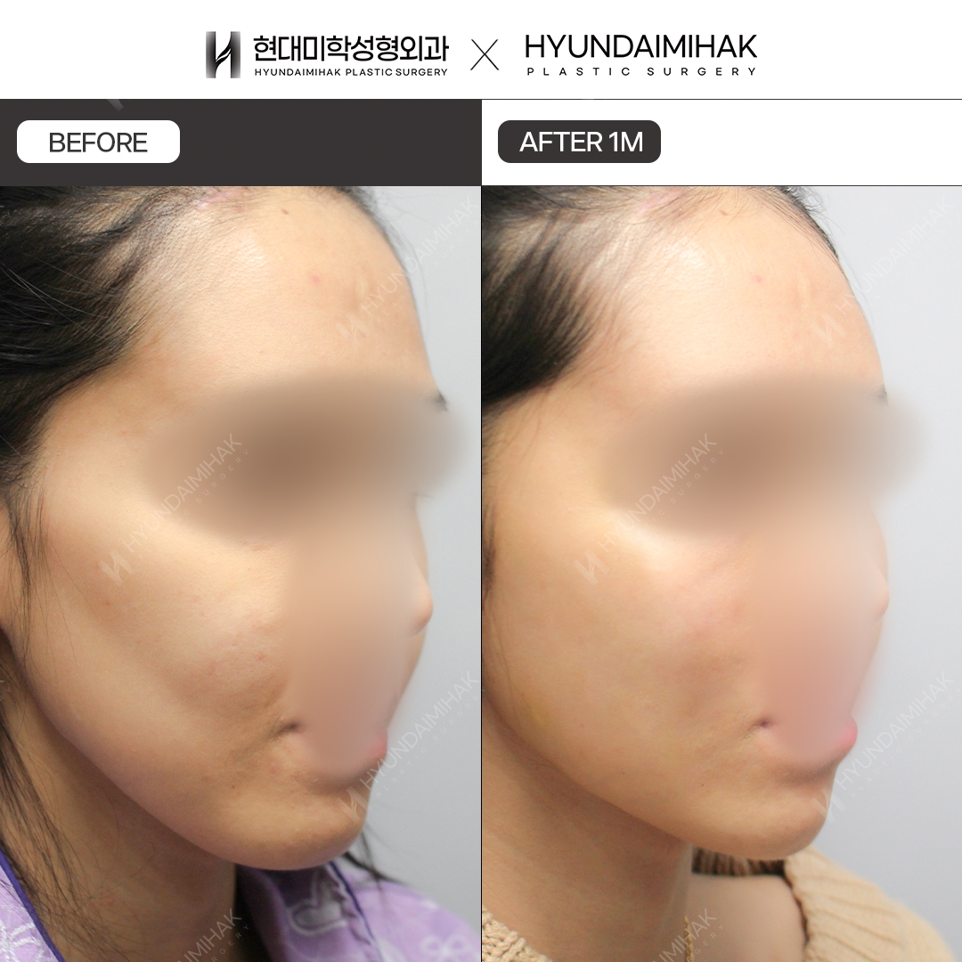 [Facial Rejuvenation] Thread Lift, 1 Month Later