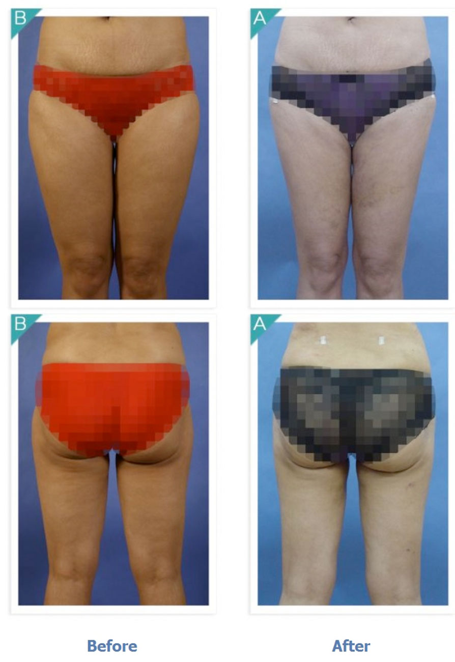Body Contouring / Thigh Liposuction