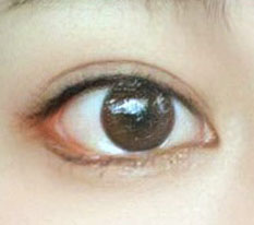 Everyone says my canthoplasty is insane?