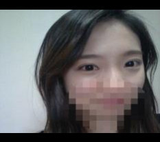 Review of incisional double-eyelid surgery and epicanthoplasty.. finally writing it lol