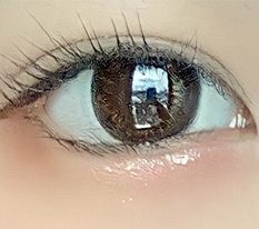 Anyone considering canthoplasty, you have to read this!