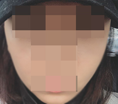 After cheekbone reduction, my impression looks completely different♥
