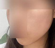 Finally, my contour injection review!