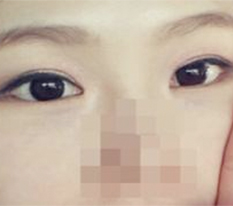 Eye surgery satisfaction review^.^/