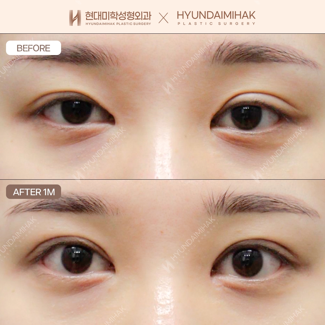 [Revision Eye Surgery] Incisional Double Eyelids + Ptosis Correction