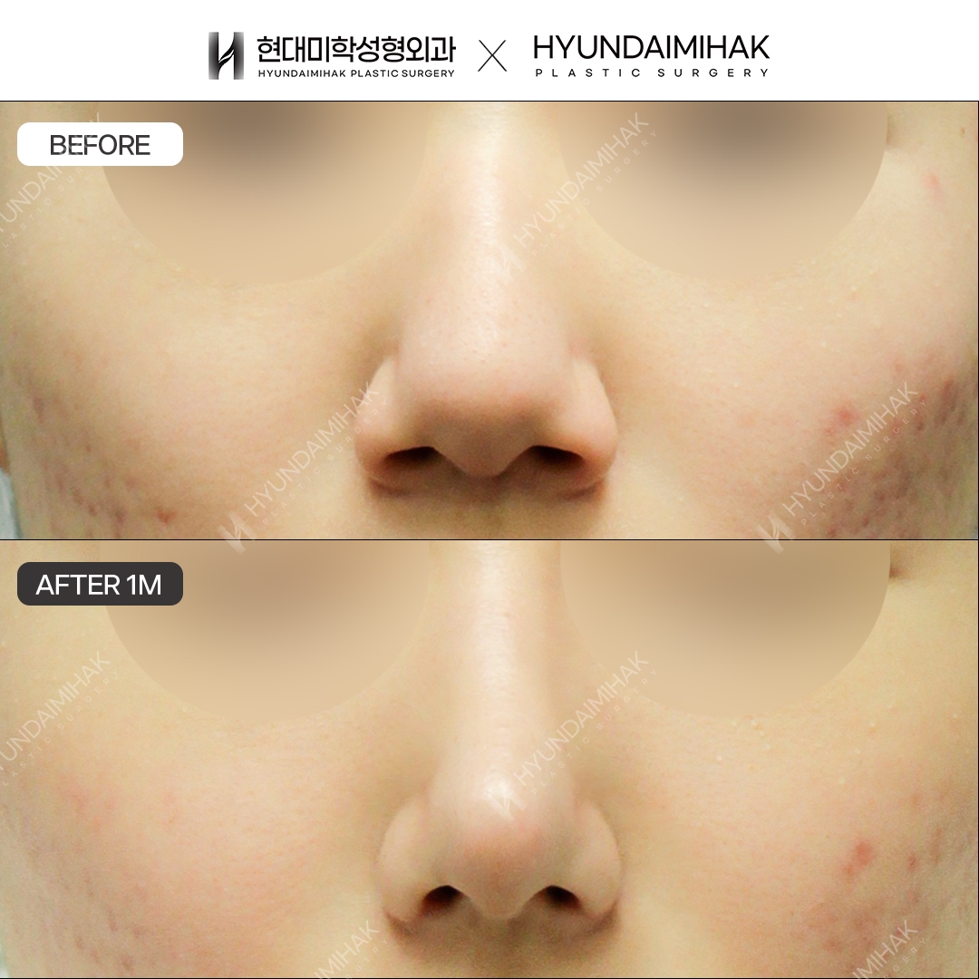 [Hump Nose Surgery] Bridge + Tip, 1 Month