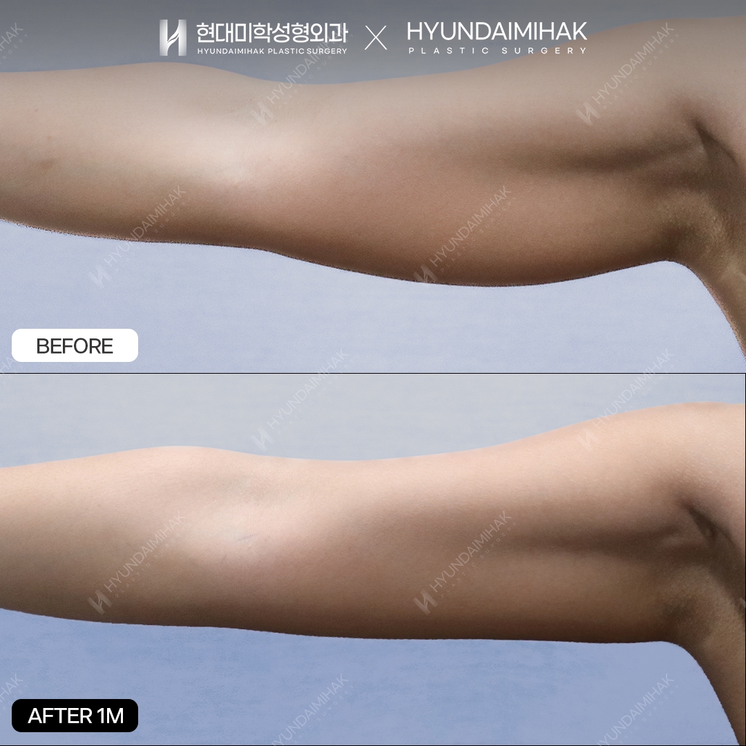 1 month after upper-arm liposuction