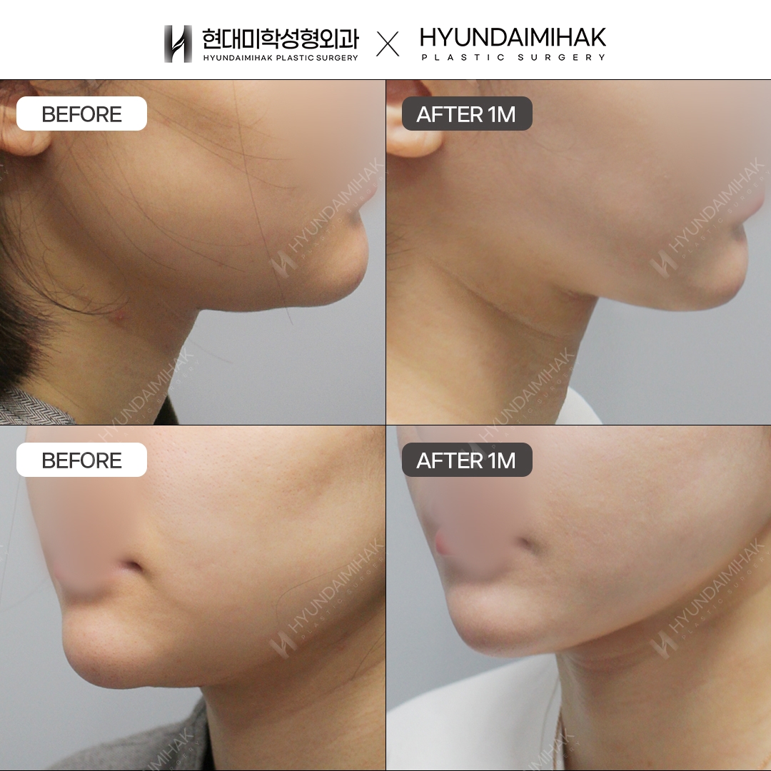 [Lifting] Double-Chin Thread Lift, 1 Month