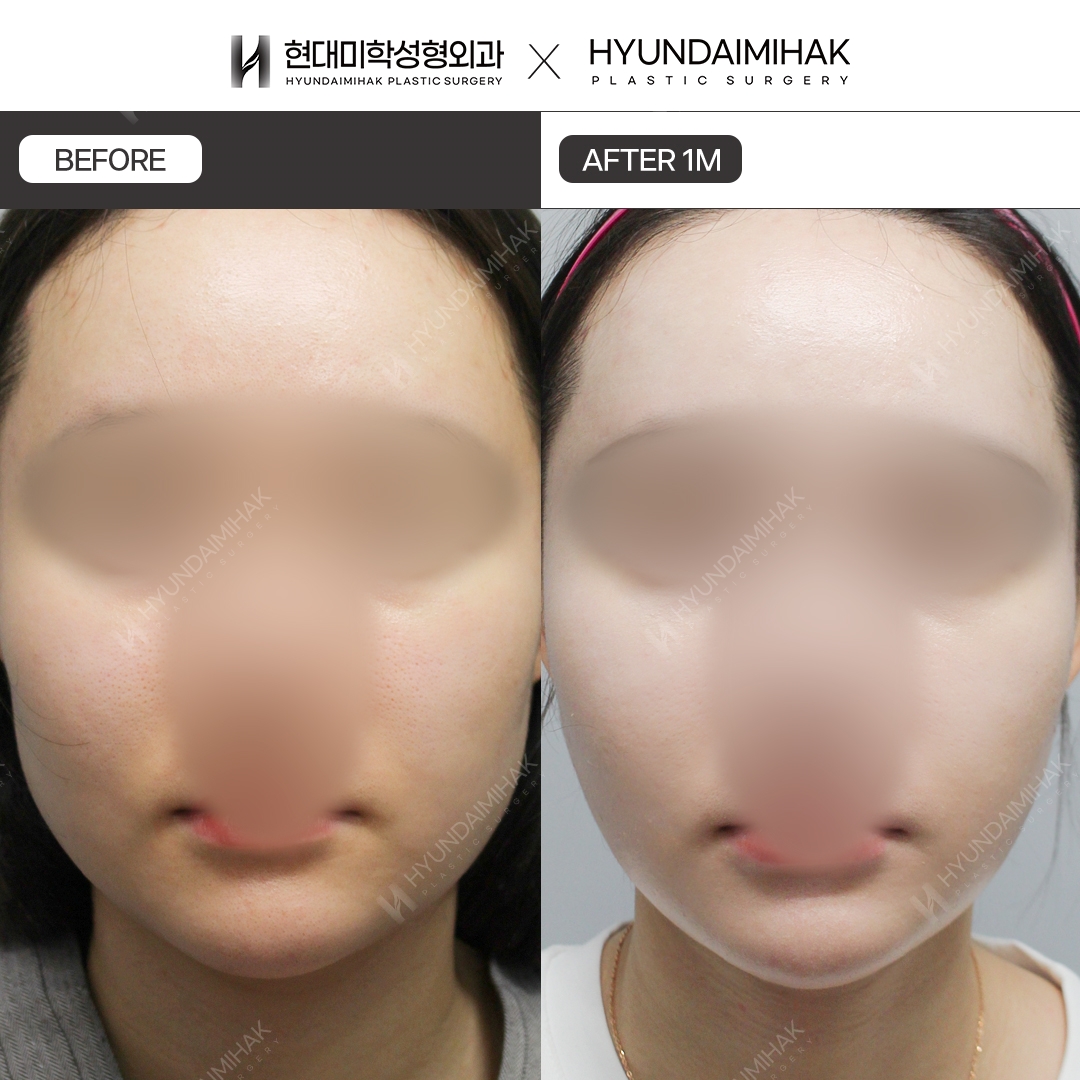 [Lifting] Double-Chin Thread Lift, 1 Month Post-Op