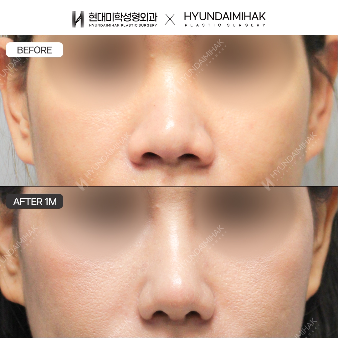 [Bulbous Nose Surgery] Nasal Bridge + Nasal Tip, 1 Month Post-Op