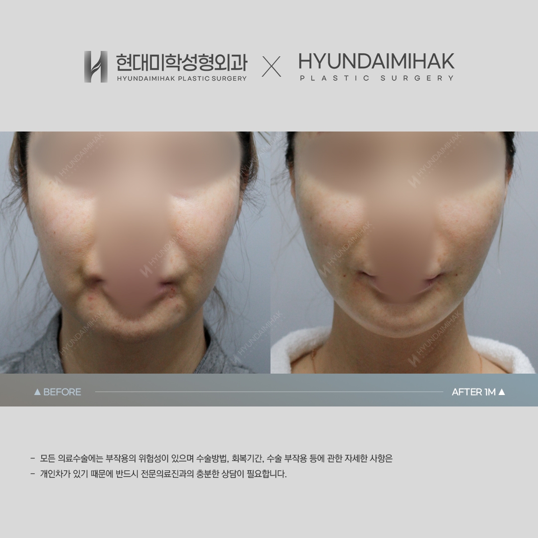 [Anti-aging Surgery] Thread lift, 1 month