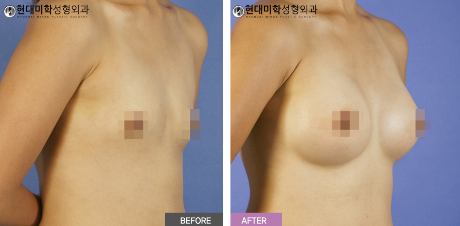 Breast Augmentation Surgery
