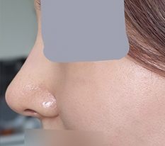 My nose changed dramatically in just one month