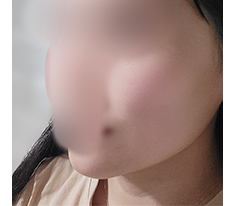 Facial Lipo + Thread Lift!!