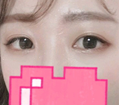 I transformed with just double-eyelid surgery!