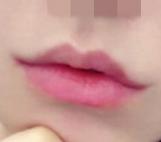 Confidence up thanks to lip corner surgery ㅋㅋ