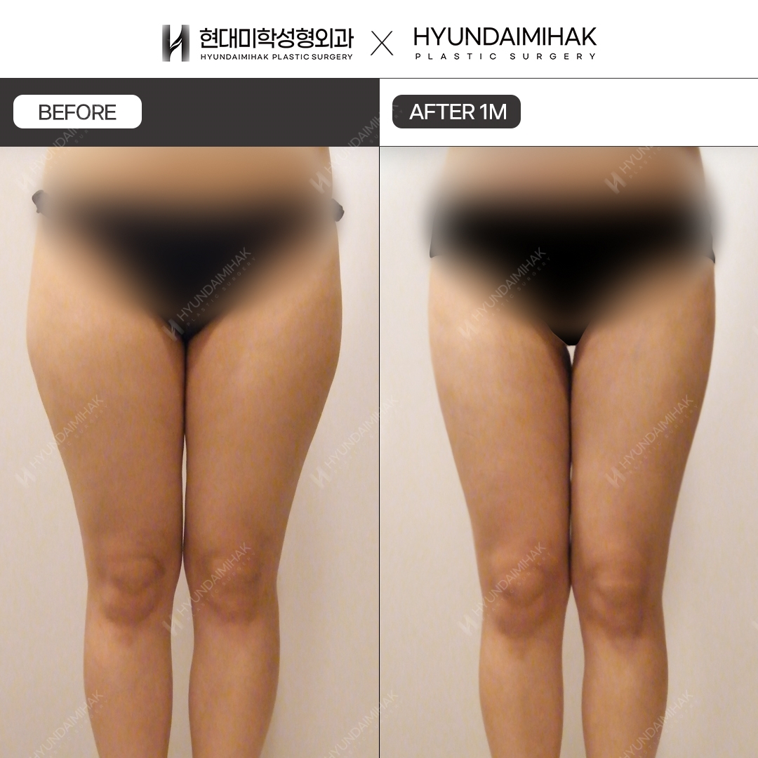 Thigh Liposuction, 1 Month