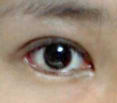 I finally had the revision eye surgery I kept putting off because I was scared