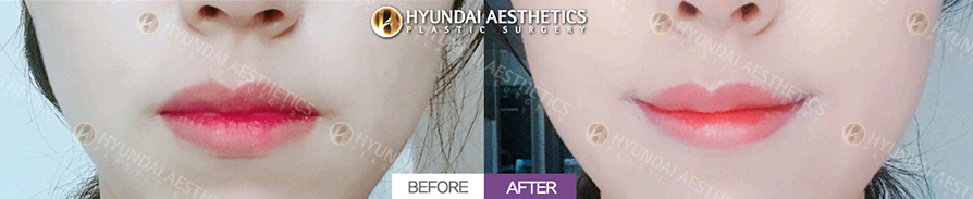 Mouth Corner Lift + Marionette Lines