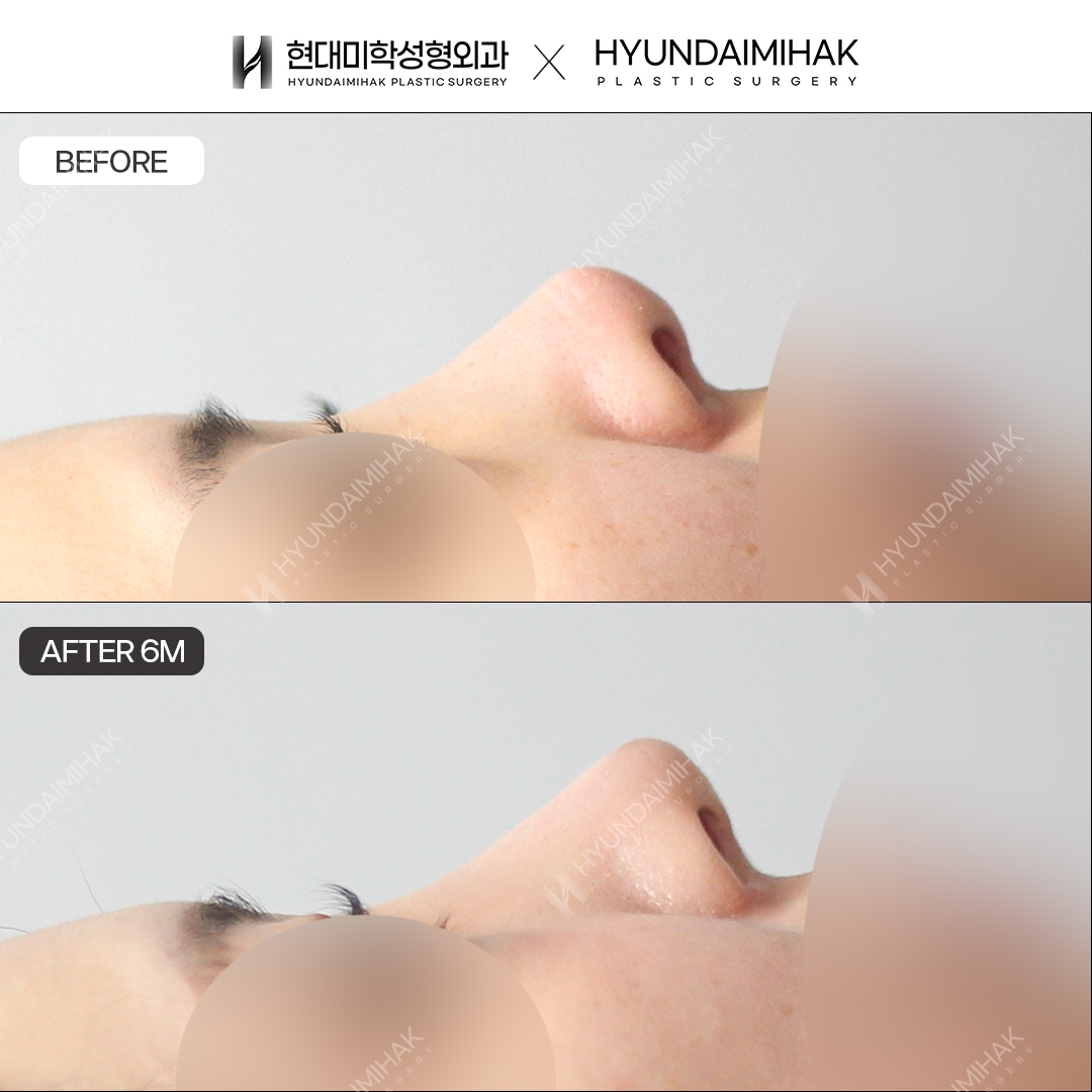 [Revision rhinoplasty] Nasal bridge + nasal tip, 6 months post-op