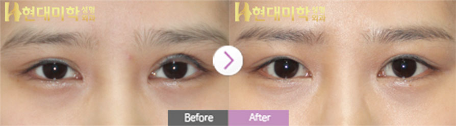 Revision Incisional Eye Surgery, Ptosis Correction